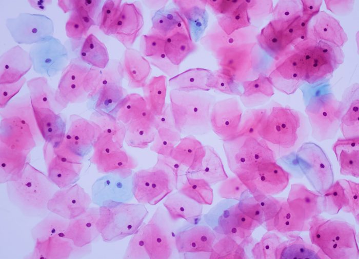 Abnormal Epithelial cells caused by HPV