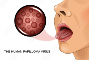 HPV on tongue illustration