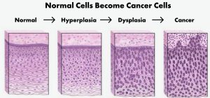 Cervical Dysplasia cells diagram